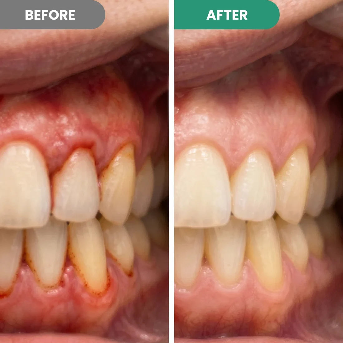 Teeth Repair Pen