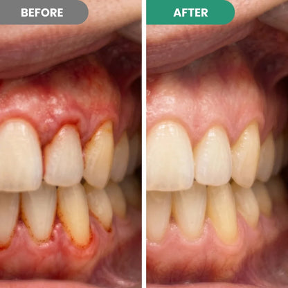 Teeth Repair Pen
